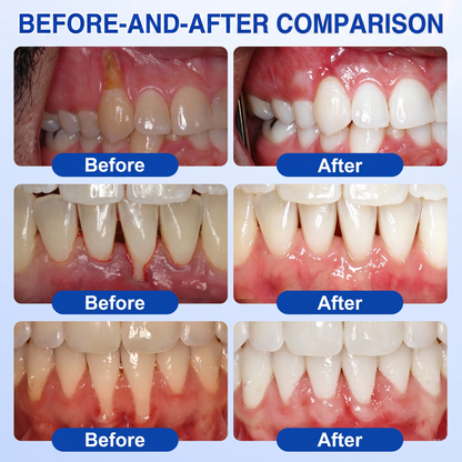 🇬🇧Pureluxo® 🦷GumRevive periodontal repair gel🌿