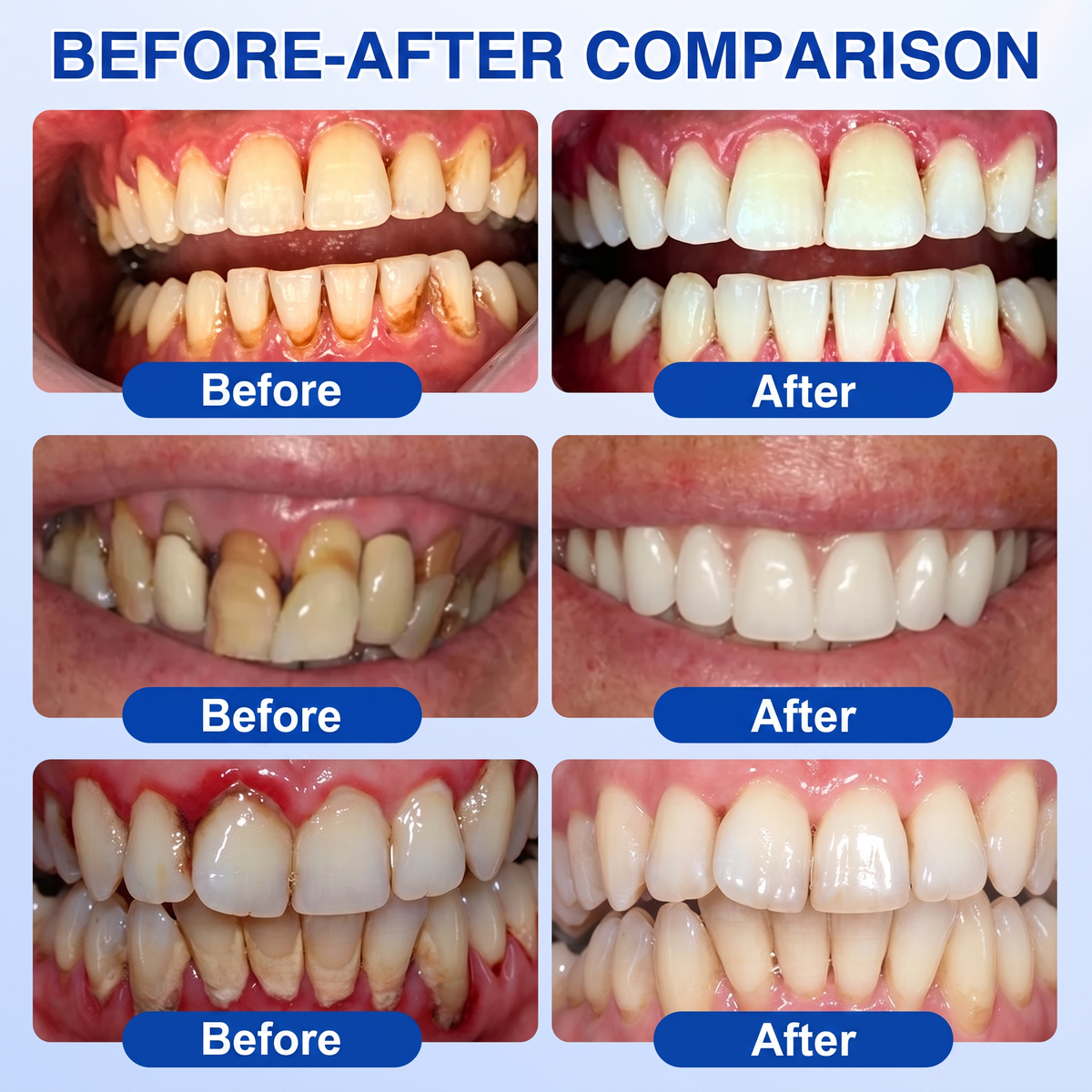 🇬🇧Pureluxo® 🦷GumRevive periodontal repair gel🌿