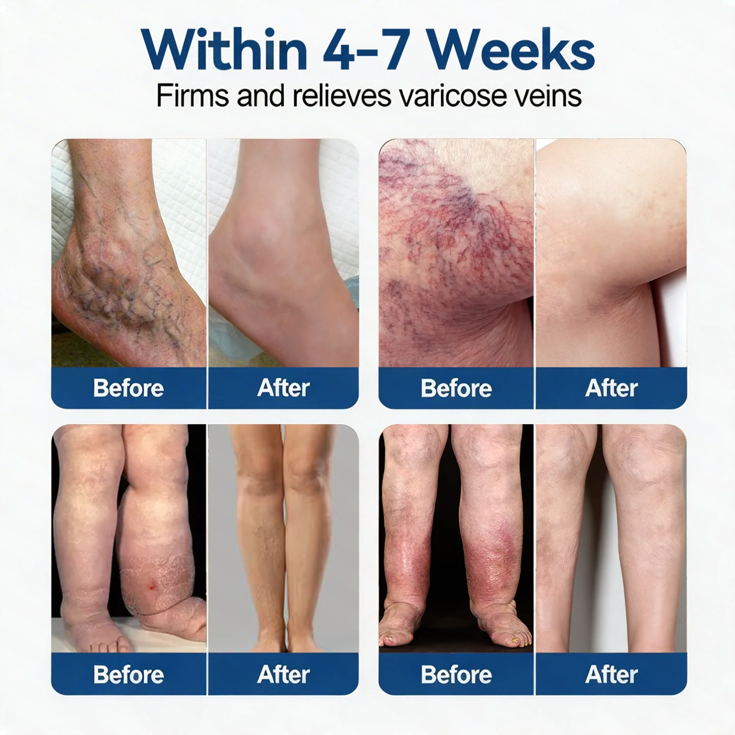 𝐏𝐮𝐫𝐞𝐥𝐮𝐱𝐨® 𝗩𝗲𝒊𝒏 𝐂𝒐𝒏𝘁𝗼𝐮𝐫 𝐌𝐢𝐜𝐫𝐨𝒏𝒆𝒆𝒅𝗹𝗲 𝑷𝒂𝒕𝐜𝐡 (𝐉𝐮𝐬𝐭 𝐎𝐧𝐜𝐞 𝐀 𝐃𝐚𝐲, 𝐒𝐞𝐞 𝐑𝐞𝐬𝐮𝐥𝐭𝐬 𝐈𝐧 𝟕 𝐃𝐚𝐲𝐬) — 👩‍⚕️🏆 𝐒𝐮𝐢𝐭𝐚𝐛𝐥𝐞 𝐅𝐨𝐫 𝐕𝐚𝐫𝐢𝐜𝐨𝐬𝐞 𝐕𝐞𝐢𝐧𝐬 𝐀𝐧𝐝 𝐒𝐩𝐢𝐝𝐞𝐫 𝐕𝐞𝐢𝐧𝐬, 𝐑𝐞𝐥𝐢𝐞𝐯𝐞𝐬 𝐇𝐞𝐚𝐯𝐲, 𝐓𝐢𝐫𝐞𝐝 𝐋𝐞𝐠🛒