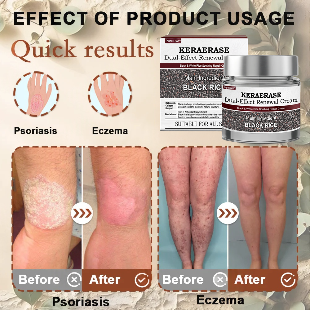 Pureluxo® KERAERASE Dual-Effect Renewal Cream — MHRA-certified treatment for abnormal skin growths and damage (suitable for warts, seborrhoeic keratosis, skin tags, keratin build-up, pigmentation, age spots, hyperplasia, and more).